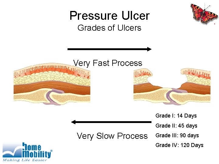 Pressure Ulcer Grades of Ulcers Very Fast Process Grade I: 14 Days Grade II: