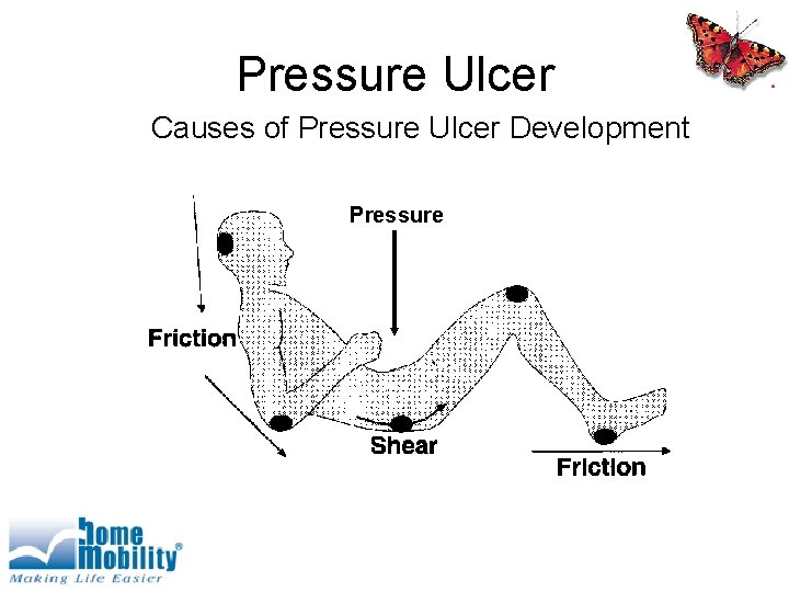 Pressure Ulcer Causes of Pressure Ulcer Development Pressure 