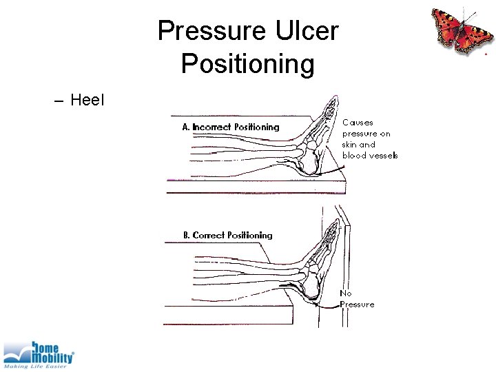 Pressure Ulcer Positioning – Heel 