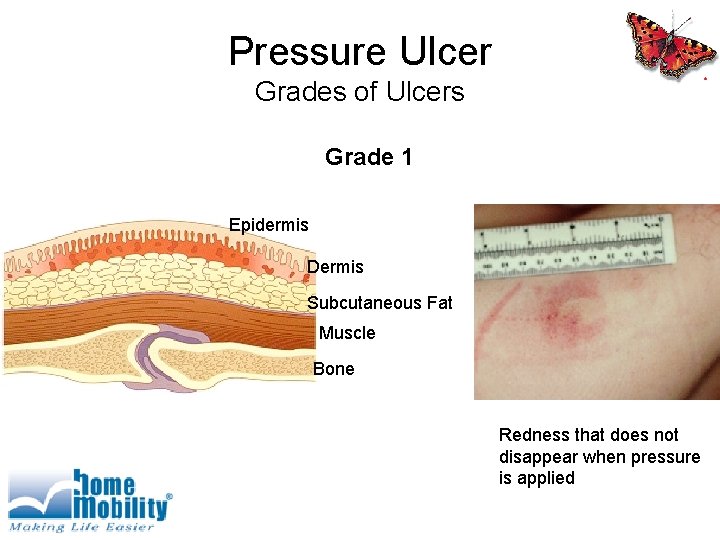 Pressure Ulcer Grades of Ulcers Grade 1 Epidermis Dermis Subcutaneous Fat Muscle Bone Redness