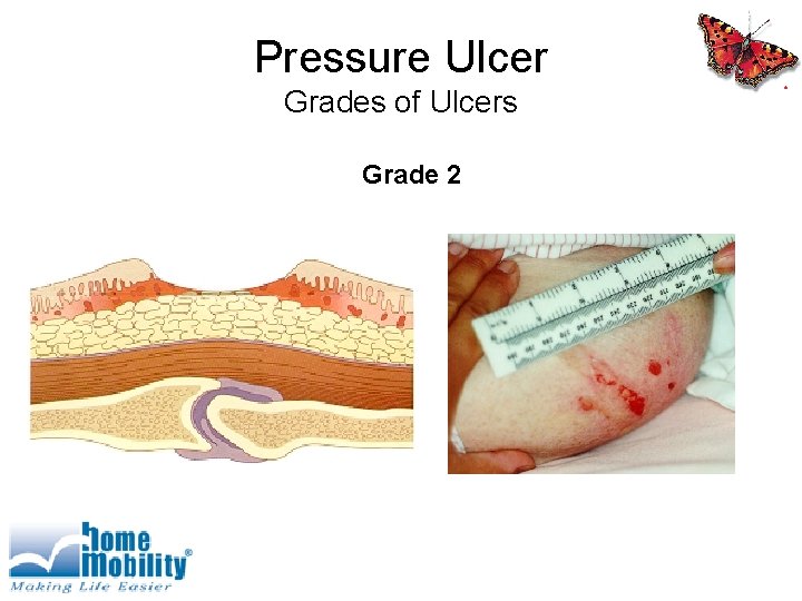 Pressure Ulcer Grades of Ulcers Grade 2 