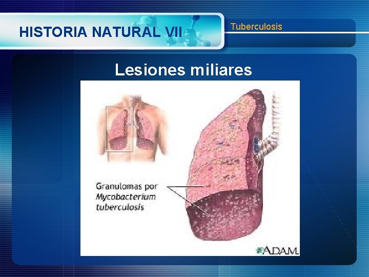 HISTORIA NATURAL VII Tuberculosis Lesiones miliares 