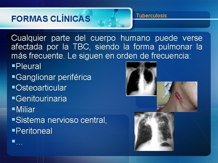 FORMAS CLÍNICAS Tuberculosis Cualquier parte del cuerpo humano puede verse afectada por la TBC,