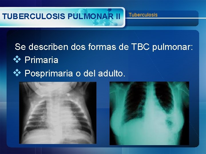 TUBERCULOSIS PULMONAR II Tuberculosis Se describen dos formas de TBC pulmonar: v Primaria v