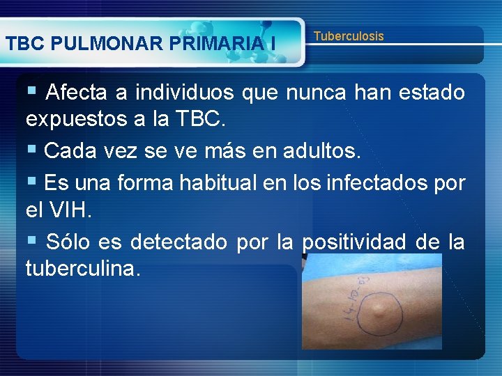 TBC PULMONAR PRIMARIA I Tuberculosis § Afecta a individuos que nunca han estado expuestos