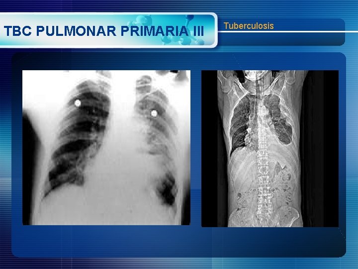 TBC PULMONAR PRIMARIA III Tuberculosis 