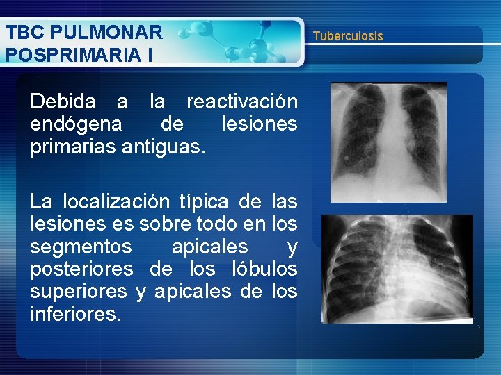 TBC PULMONAR POSPRIMARIA I Debida a la reactivación endógena de lesiones primarias antiguas. La