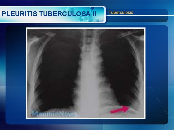 PLEURITIS TUBERCULOSA II Tuberculosis 