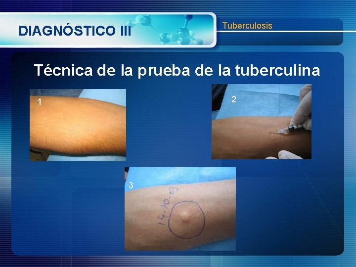 DIAGNÓSTICO III Tuberculosis Técnica de la prueba de la tuberculina 2 1 ARTICLE 3