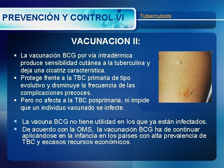 PREVENCIÓN Y CONTROL VI Tuberculosis VACUNACION II: § La vacunación BCG por vía intradérmica