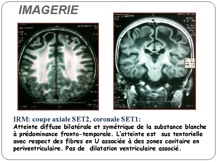 IMAGERIE IRM: coupe axiale SET 2, coronale SET 1: Atteinte diffuse bilatérale et symétrique