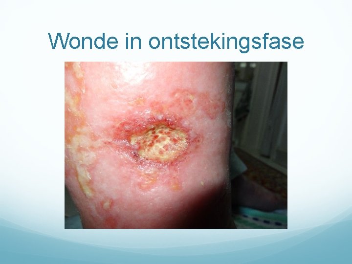 Wonde in ontstekingsfase 