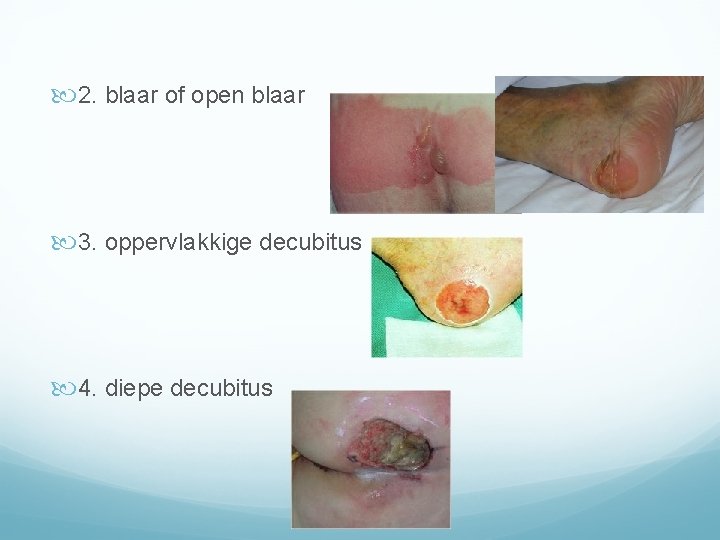  2. blaar of open blaar 3. oppervlakkige decubitus 4. diepe decubitus 