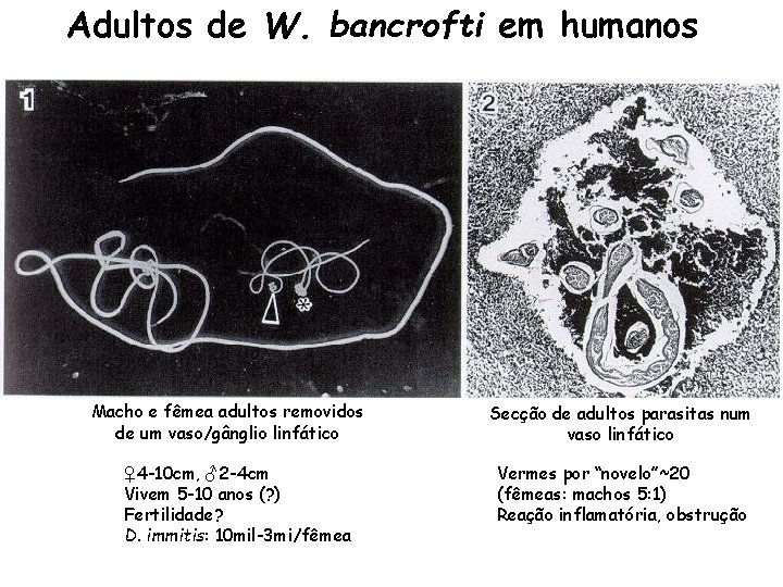 Adultos de W. bancrofti em humanos Macho e fêmea adultos removidos de um vaso/gânglio