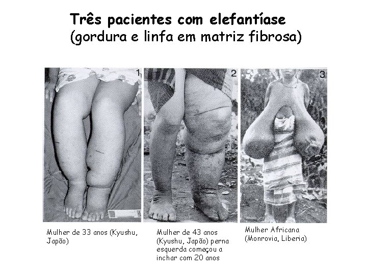 Três pacientes com elefantíase (gordura e linfa em matriz fibrosa) Mulher de 33 anos