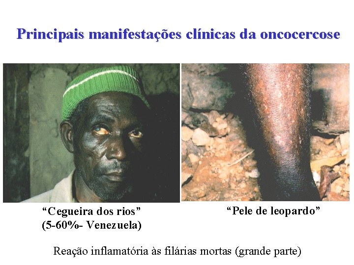 Principais manifestações clínicas da oncocercose “Cegueira dos rios” (5 -60%- Venezuela) “Pele de leopardo”