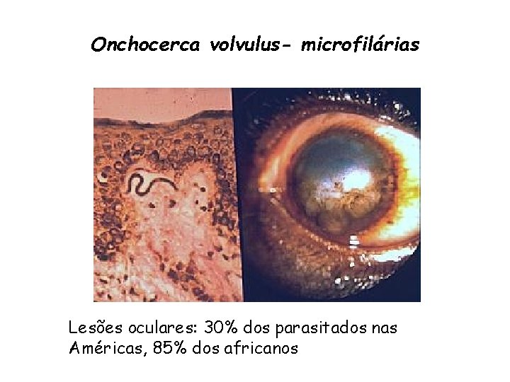 Onchocerca volvulus- microfilárias Lesões oculares: 30% dos parasitados nas Américas, 85% dos africanos 