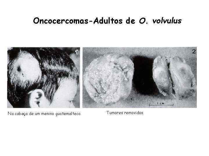 Oncocercomas-Adultos de O. volvulus Na cabeça de um menino guatemalteco Tumores removidos 