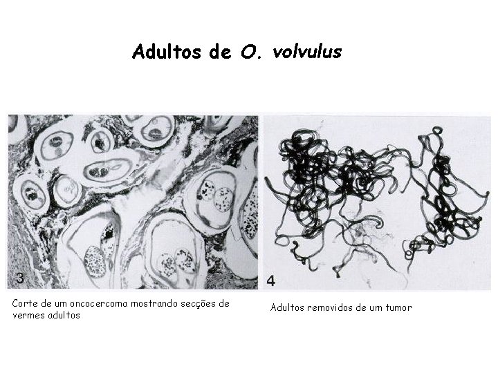 Adultos de O. volvulus Corte de um oncocercoma mostrando secções de vermes adultos Adultos