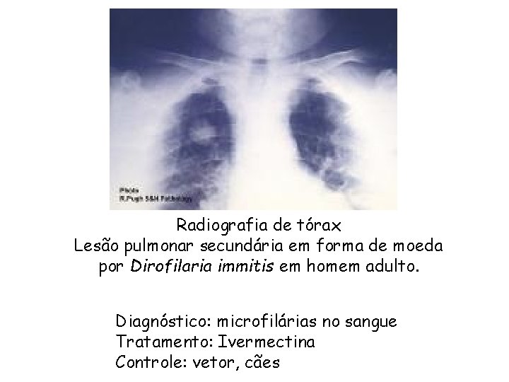 Radiografia de tórax Lesão pulmonar secundária em forma de moeda por Dirofilaria immitis em