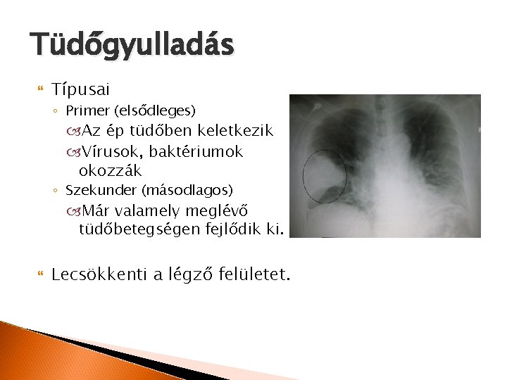 Tüdőgyulladás Típusai ◦ Primer (elsődleges) Az ép tüdőben keletkezik Vírusok, baktériumok okozzák ◦ Szekunder