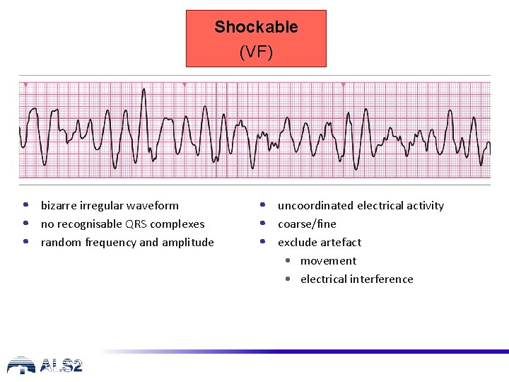 Shockable (VF) • bizarre irregular waveform • no recognisable QRS complexes • random frequency