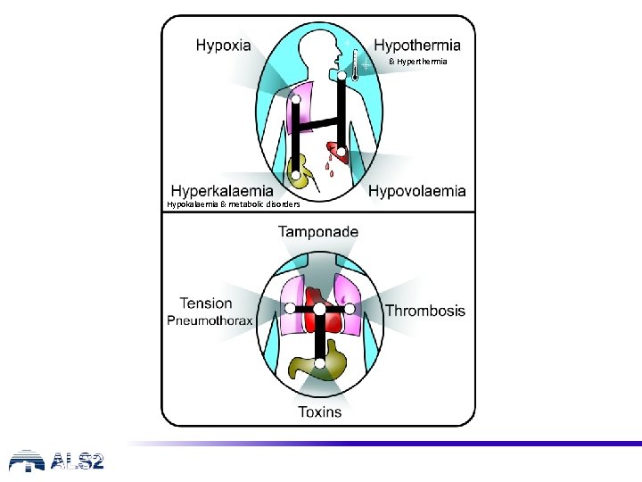 & Hyperthermia Hypokalaemia & metabolic disorders 