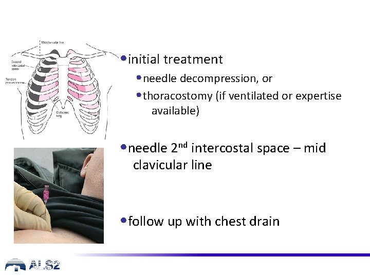  • initial treatment • needle decompression, or • thoracostomy (if ventilated or expertise