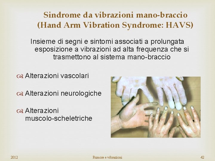 Sindrome da vibrazioni mano-braccio (Hand Arm Vibration Syndrome: HAVS) Insieme di segni e sintomi