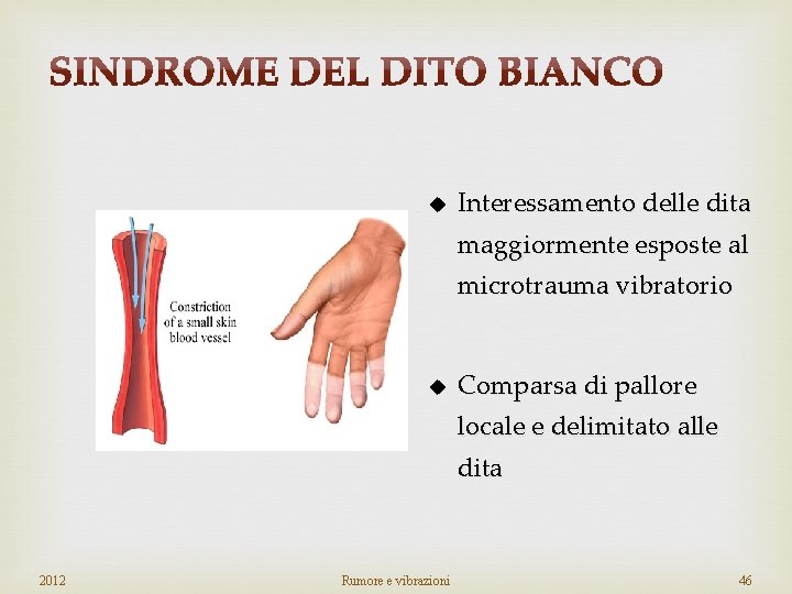 u Interessamento delle dita maggiormente esposte al microtrauma vibratorio u Comparsa di pallore locale