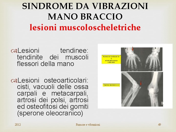 SINDROME DA VIBRAZIONI MANO BRACCIO lesioni muscoloscheletriche Lesioni tendinee: tendinite dei muscoli flessori della