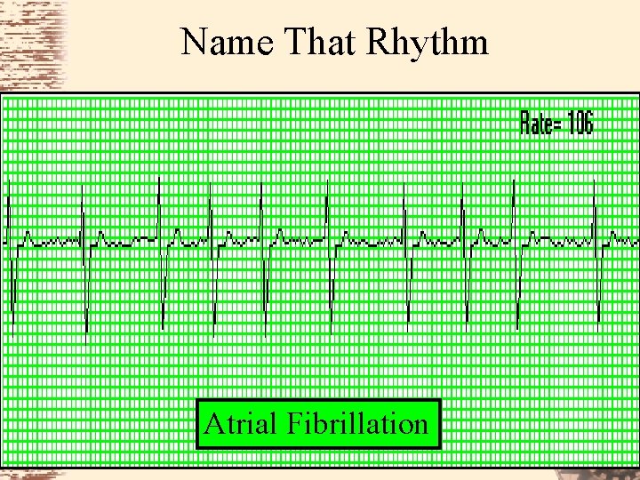 Name That Rhythm Atrial Fibrillation 