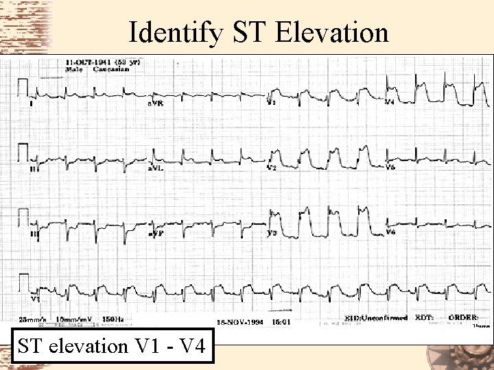 Identify ST Elevation ST elevation V 1 - V 4 