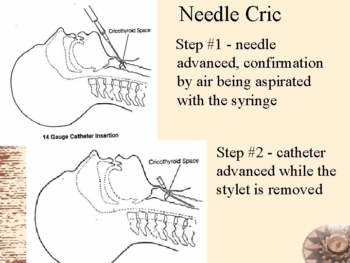 Needle Cric Step #1 - needle advanced, confirmation by air being aspirated with the