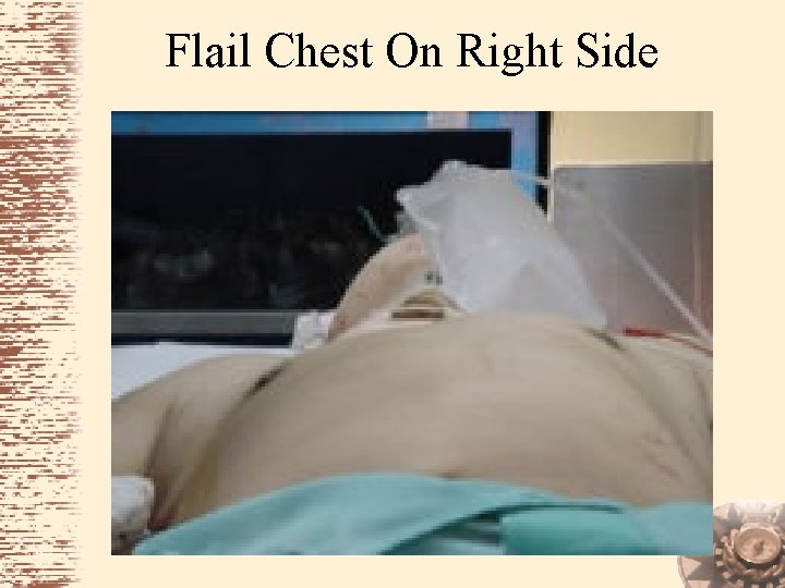 Flail Chest On Right Side 