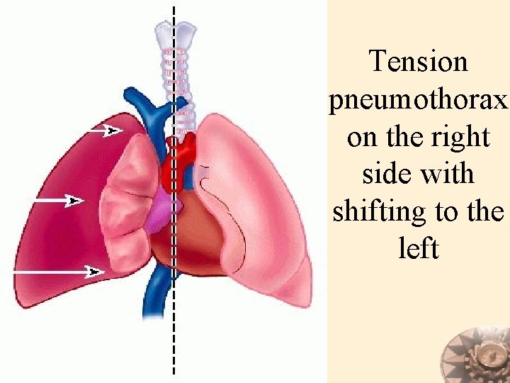 Tension pneumothorax on the right side with shifting to the left 