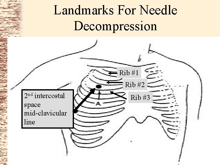 Landmarks For Needle Decompression Rib #1 Rib #2 2 nd intercostal space mid-clavicular line