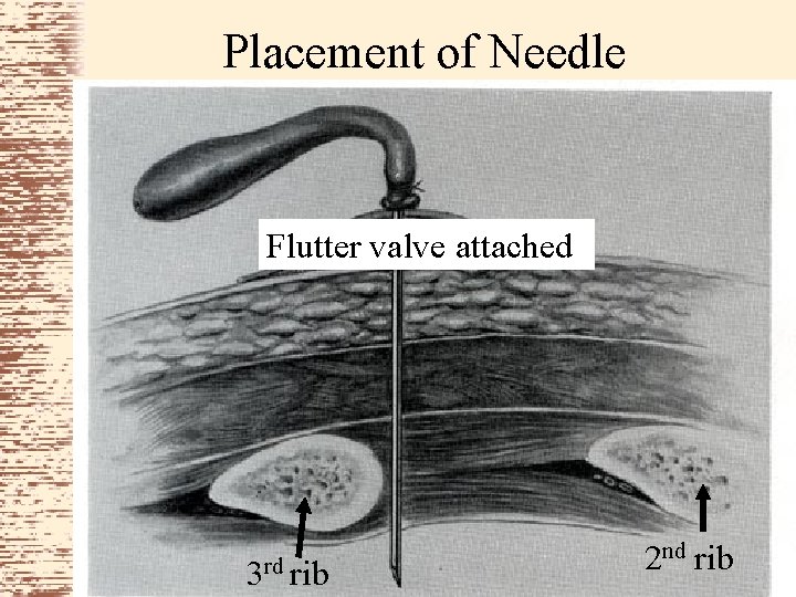Placement of Needle Flutter valve attached 3 rd rib 2 nd rib 