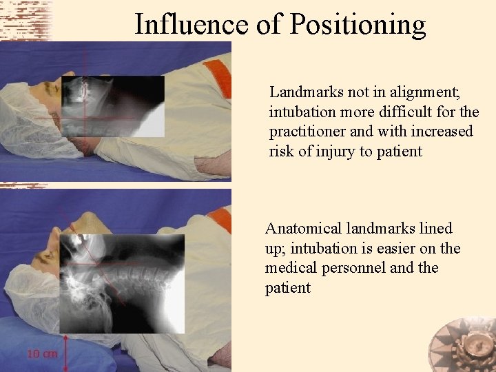 Influence of Positioning Landmarks not in alignment; intubation more difficult for the practitioner and