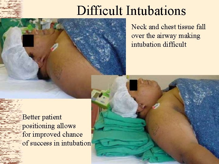 Difficult Intubations Neck and chest tissue fall over the airway making intubation difficult Better