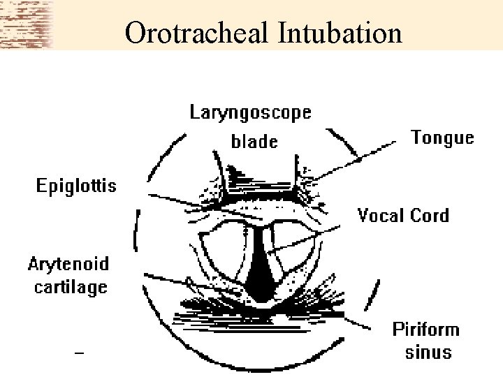 Orotracheal Intubation 