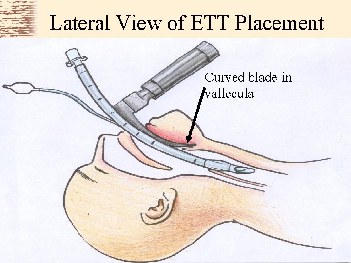 Lateral View of ETT Placement Curved blade in vallecula 
