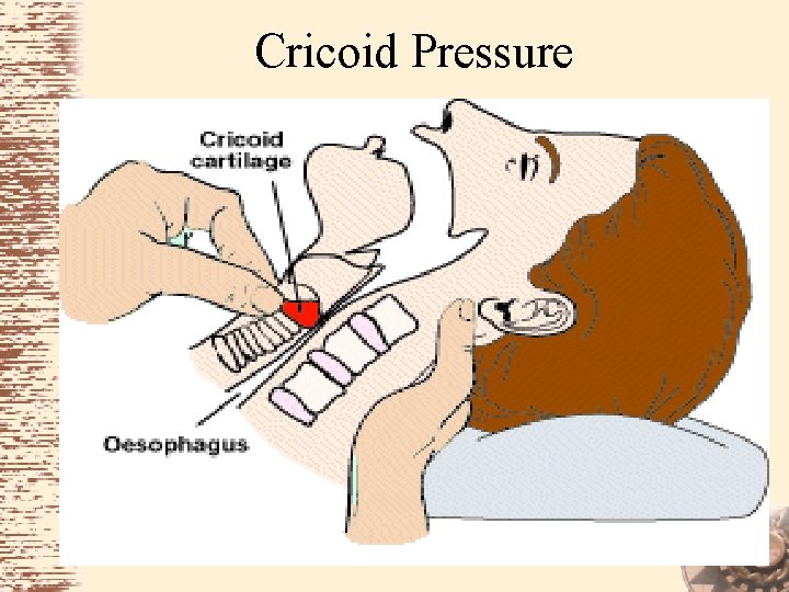 Cricoid Pressure 