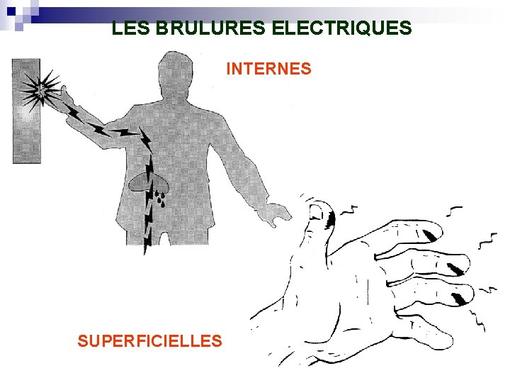 LES BRULURES ELECTRIQUES INTERNES SUPERFICIELLES 