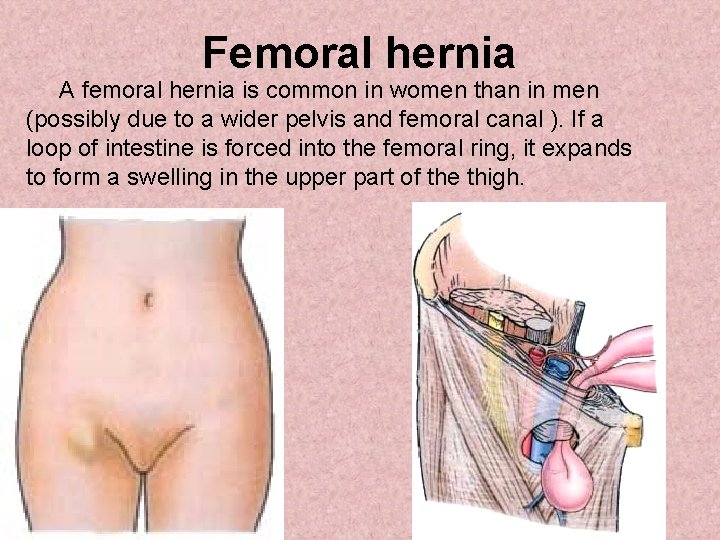 Femoral hernia A femoral hernia is common in women than in men (possibly due