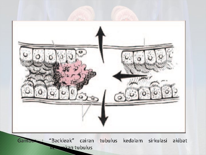 Gambar : “Backleak” cairan tubulus kedalam sirkulasi akibat kerusakan tubulus 