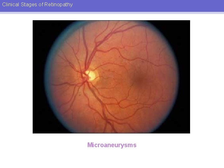 Clinical Stages of Retinopathy Microaneurysms 