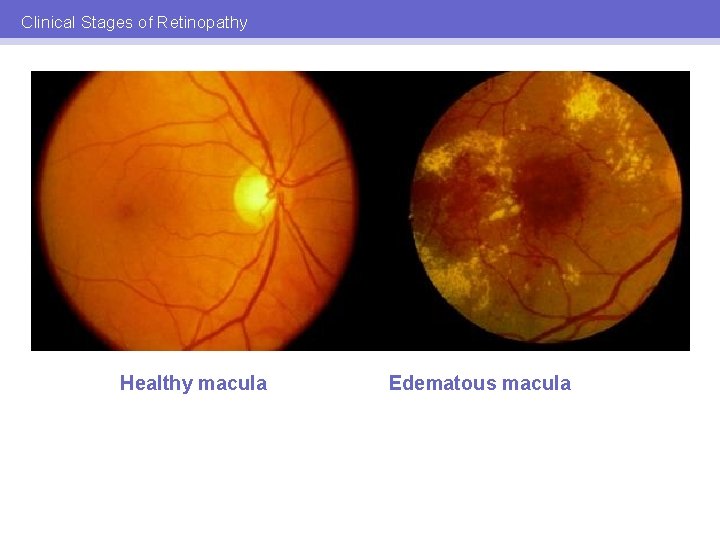 Clinical Stages of Retinopathy Healthy macula Edematous macula 