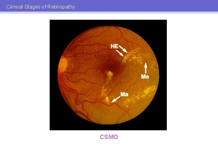 Clinical Stages of Retinopathy CSMO 