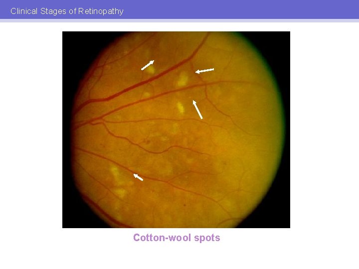 Clinical Stages of Retinopathy Cotton-wool spots 